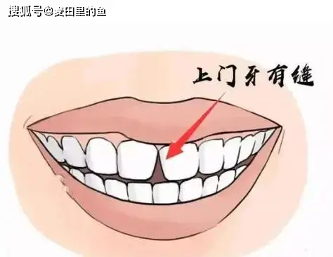 牙齒縫隙大有什么好的方法解決？